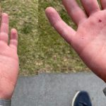 Ben's fall/running injury