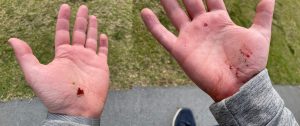 Ben's fall/running injury